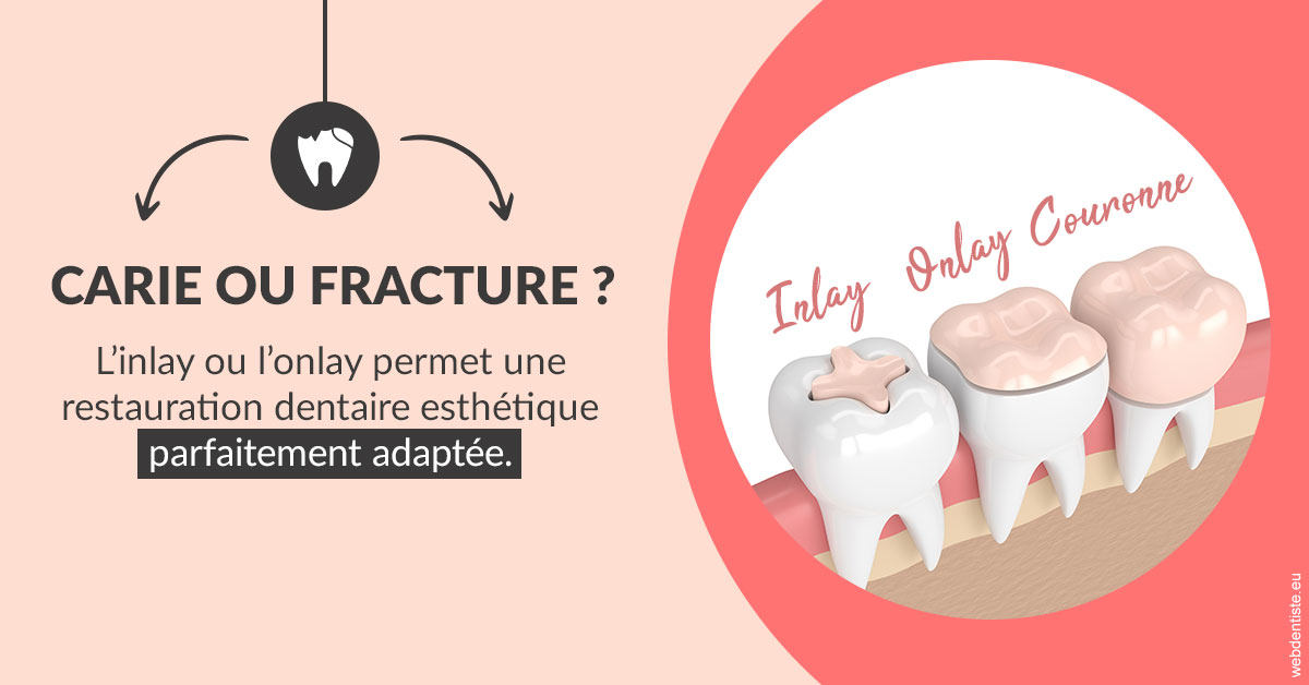 https://dr-bourdin-david.chirurgiens-dentistes.fr/T2 2023 - Carie ou fracture 2