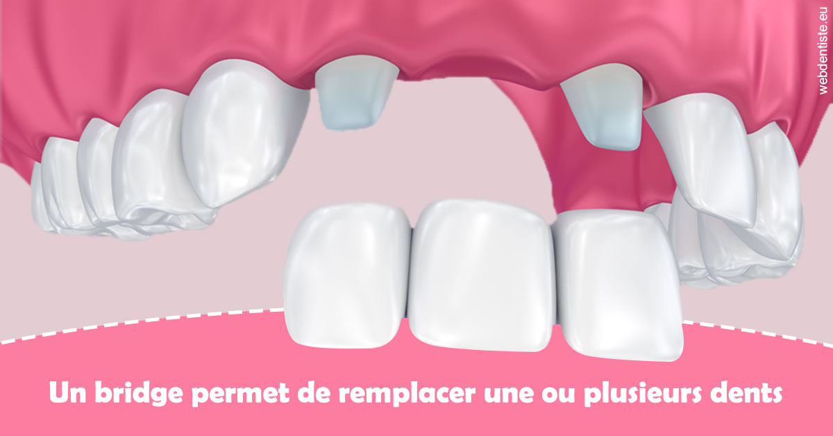 https://dr-bourdin-david.chirurgiens-dentistes.fr/Bridge remplacer dents 2