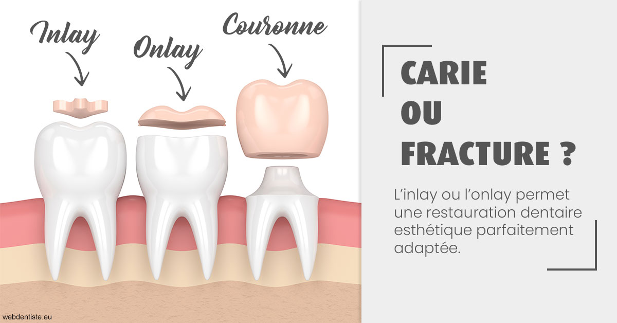 https://dr-bourdin-david.chirurgiens-dentistes.fr/T2 2023 - Carie ou fracture 1