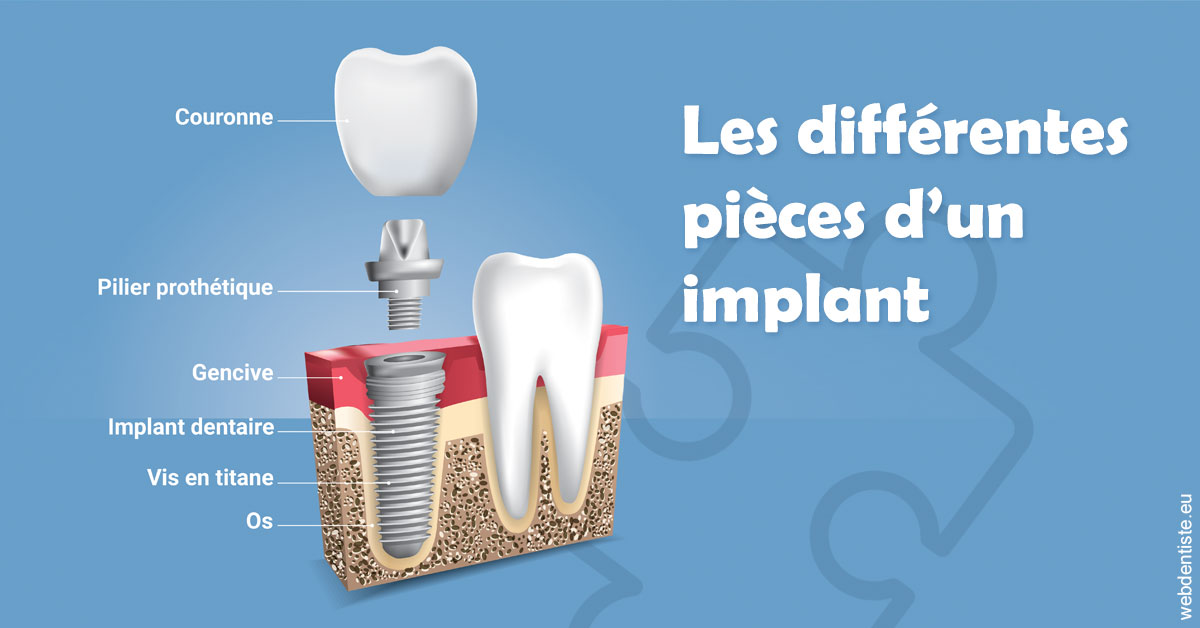 https://dr-bourdin-david.chirurgiens-dentistes.fr/Les différentes pièces d’un implant 1